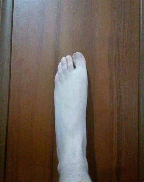 büyük ayağın artrozu